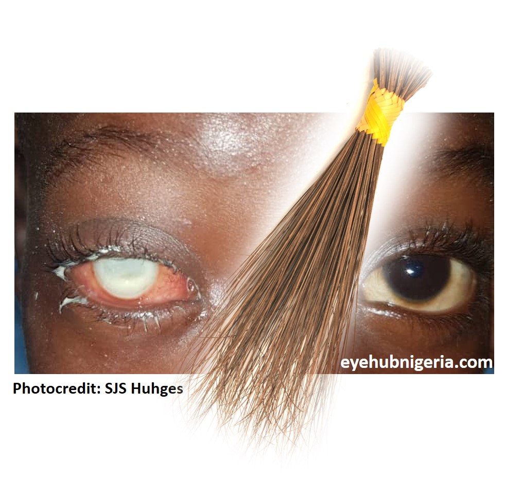 Preventing eye injuries from broom sticks - By Dr Fumbi Adeboye || Eyehub Nigeria